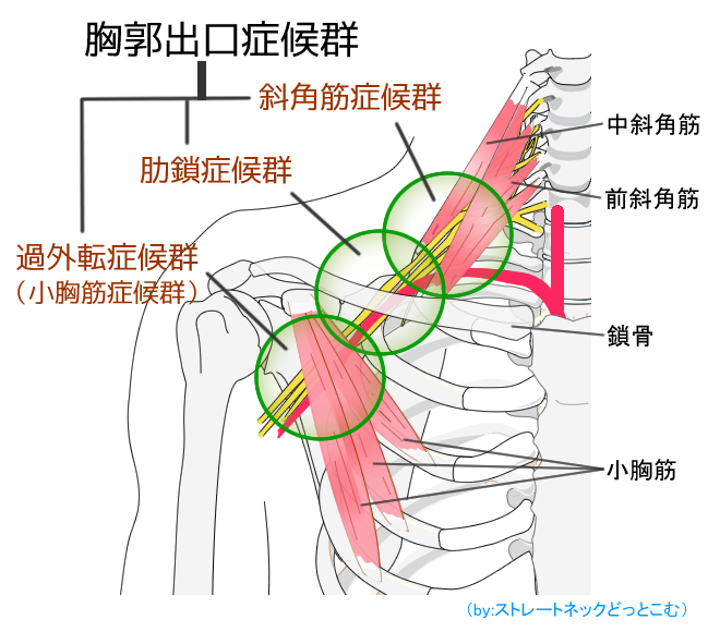 胸郭出口症候群